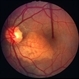 Choroidal osteoma case 1 no 3
